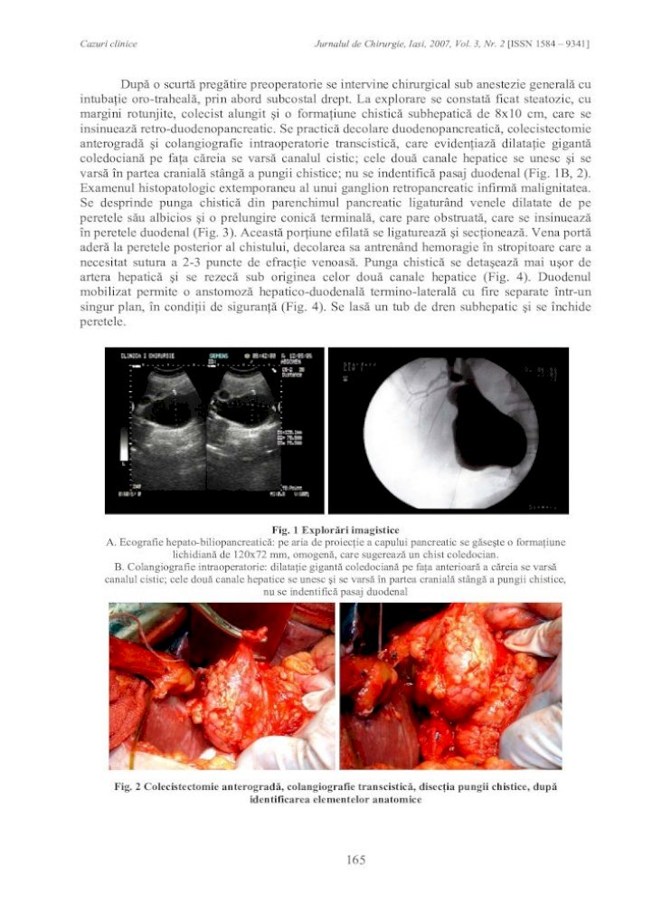 chist duodenal